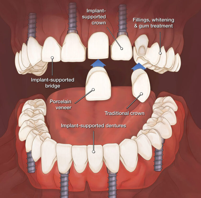 Full mouth reconstruction Indore 768x756 1