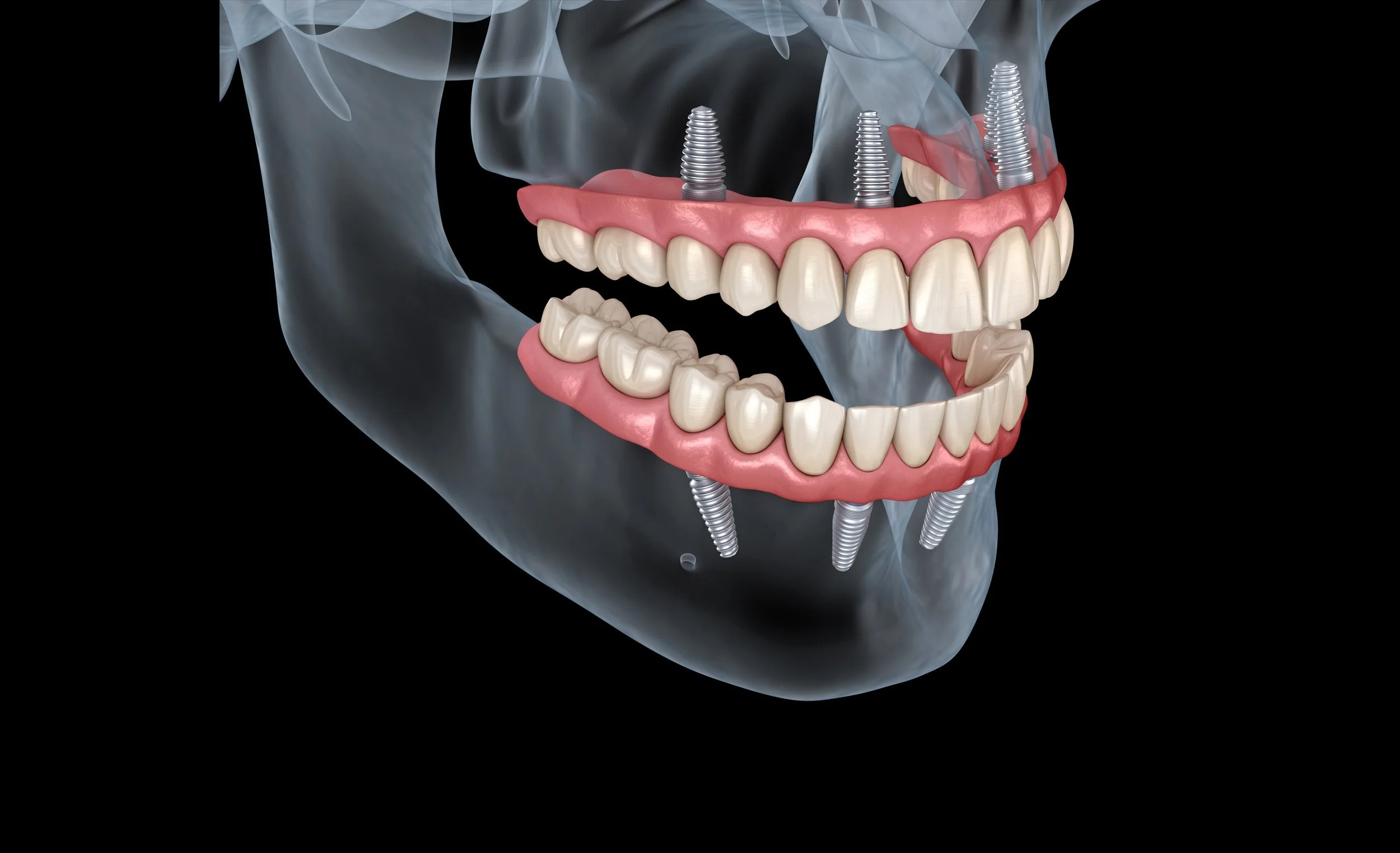 MicroDental