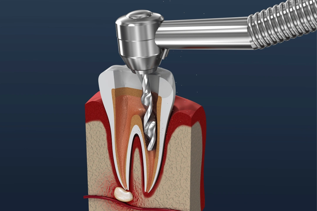 Root Canal Treatment