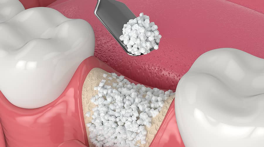 bone grafting