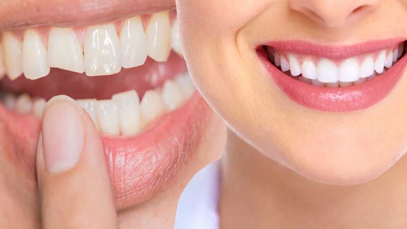 cosmetic dental bonding