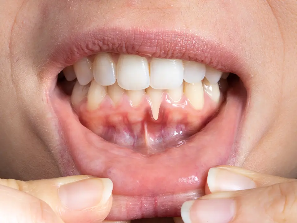 gingivitis gum health