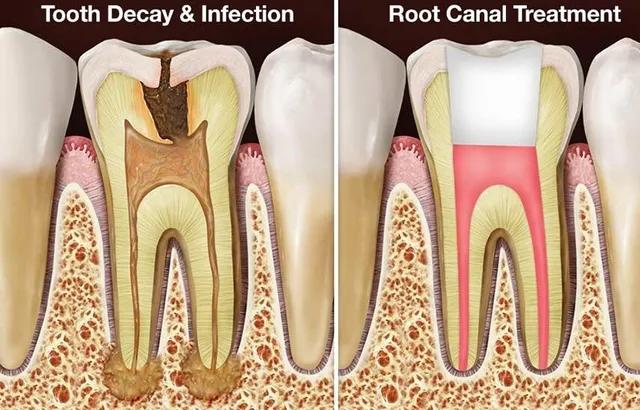 root canal 640w